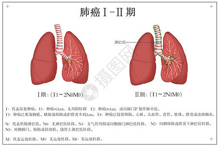 肺癌发展阶段医疗插画背景图片