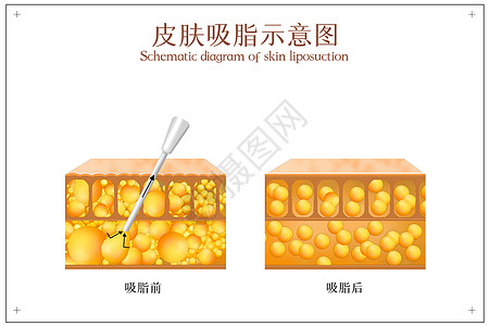 吸脂后皮肤对比示意图高清图片