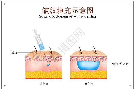 皮肤整形皮肤美容之皱纹填充插画