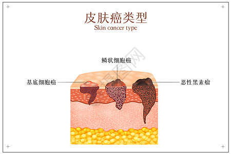 癌症日皮肤癌症类型示意图插画