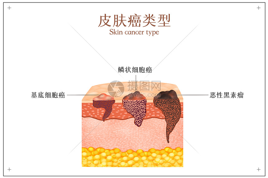 皮肤癌症类型示意图图片