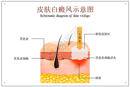 美容美妆皮肤白癜风示意图插画