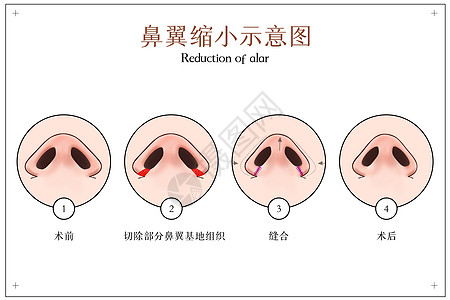 鼻翼缩小手术示意图高清图片