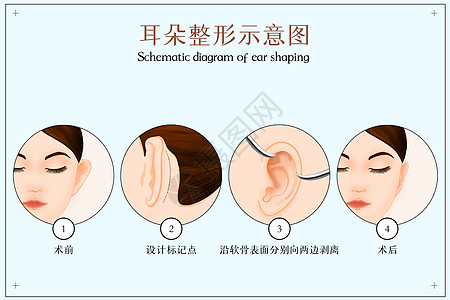 耳朵整形示意图图片