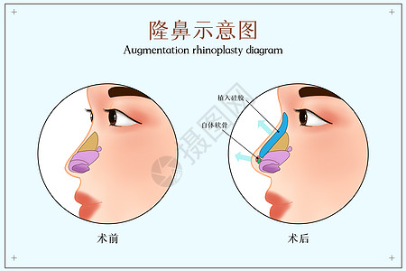 隆鼻示意图图片