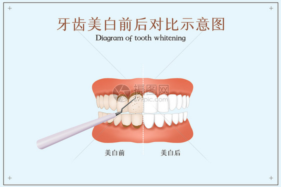 牙齿美白前后对比示意图图片