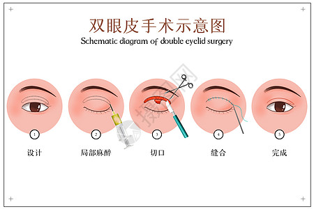 双眼皮手术示意图图片