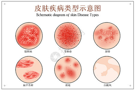 皮肤病示意图图片