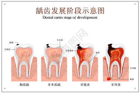 管局龋齿发展阶段示意图插画