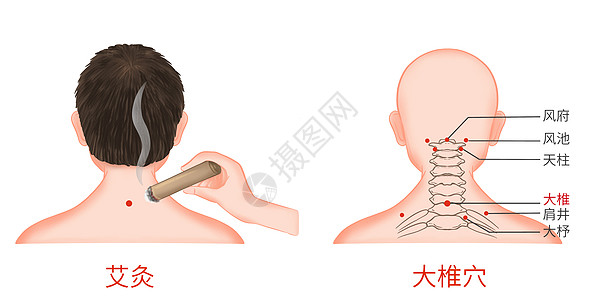 颈椎疼痛颈椎病大椎穴艾灸医疗插画插画