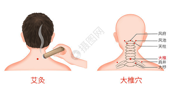 颈椎病大椎穴艾灸医疗插画图片