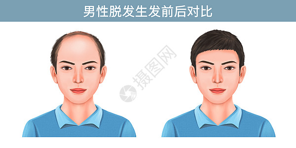 中年男性肖像男性脱发生发前后对比插画插画