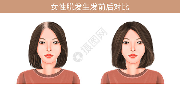 中年女人女性脱发生发前后对比插画插画