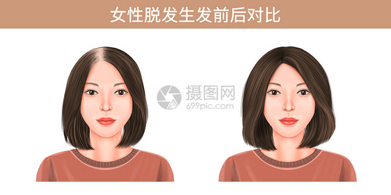 女性脱发生发前后对比插画图片