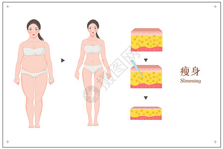 女性抽指瘦身对比图医美插图高清图片