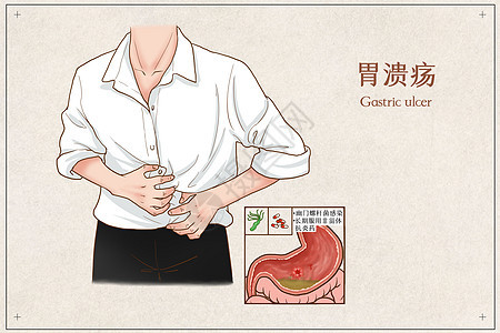 胃溃疡医疗插画消化内科高清图片素材
