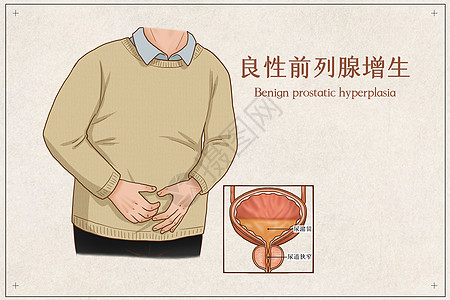 良性前列腺增生医疗插画背景图片