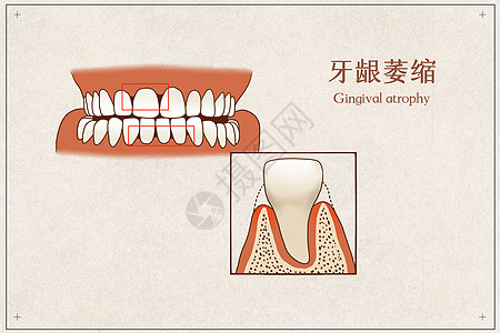 牙龈萎缩医疗插画高清图片