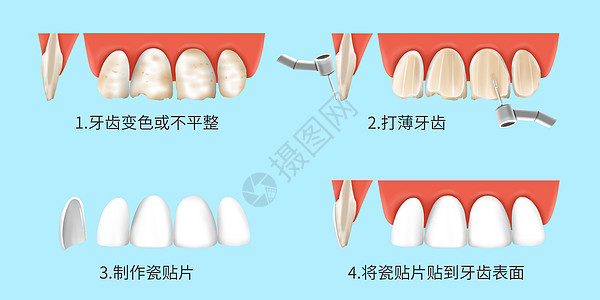 瓷贴面的治疗过程医疗插画高清图片