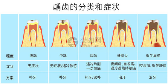 龋齿的分类和症状科普医疗插画图片