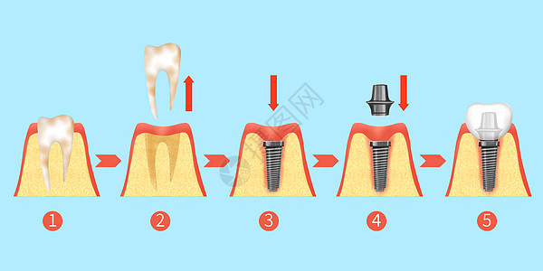 牙齿种植牙治疗过程步骤医疗插画高清图片