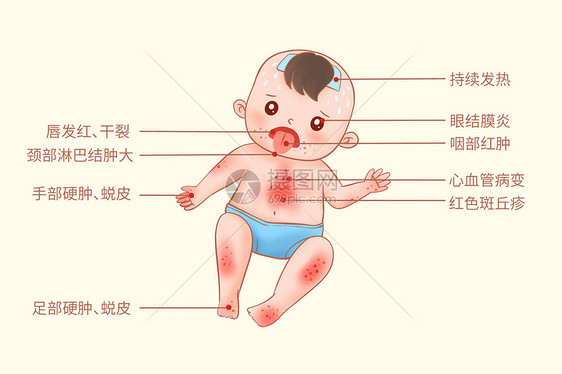 麻疹皮肤病发病症状医疗插画图片