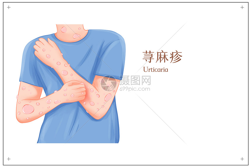 皮肤病过敏性荨麻疹医疗插画图片