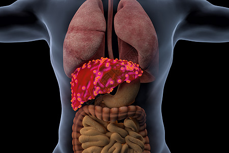 人体肝脏病变图片