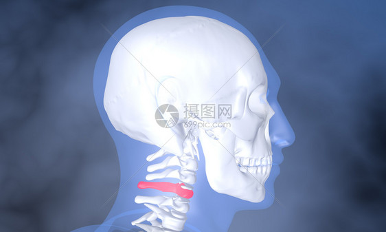 颈部骨骼病灶图片