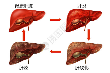 乙肝肝脏病变症状医疗插画图片