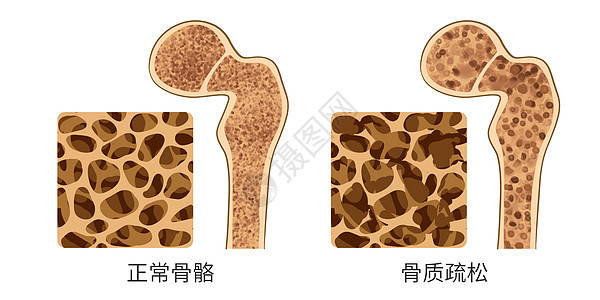 正常骨质和骨质疏松对比医疗插画图片