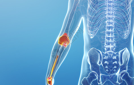 3D手腕关节疾病背景图片