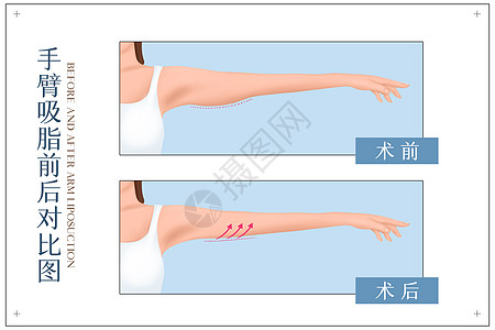 健身前后对比手臂吸脂前手术前后对比示意图插画