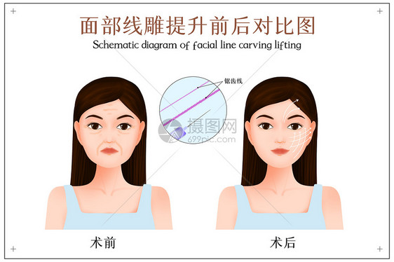 面部线雕提拉手术前后对比示意图图片