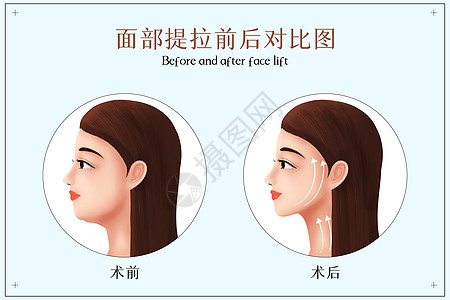 女人肌肤面部皮肤提拉前后对比图插画