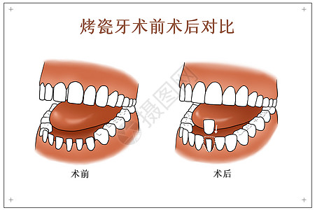 烤瓷牙术前术后对比口腔医学配图图片