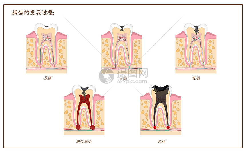 龋齿发展过程口腔医学配图
