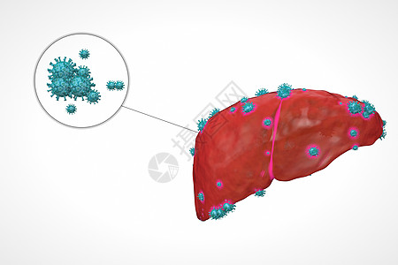 乙肝病变肝炎病毒高清图片