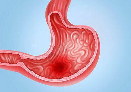 胃炎医疗健康插图背景图片