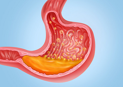 结果分析胃胀医疗健康插图插画