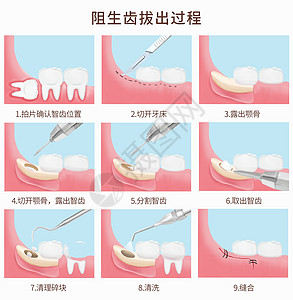 阻生齿拔出过程医疗插图高清图片