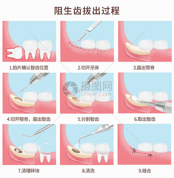 阻生齿拔出过程医疗插图图片