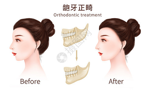 龅牙牙齿矫正医疗插图图片