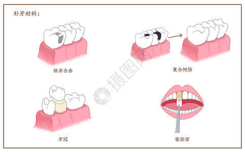 补牙材料口腔医学配图背景图片