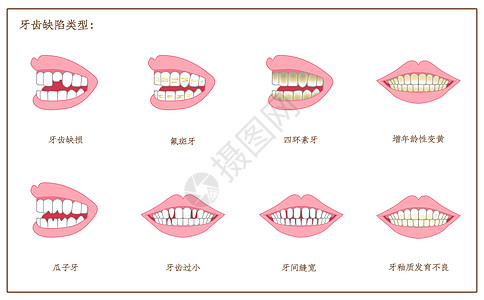 牙齿缺陷口腔医学配图图片