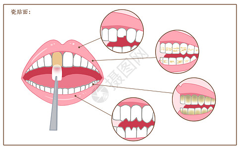 牙齿瓷贴面修复口腔医学配图高清图片