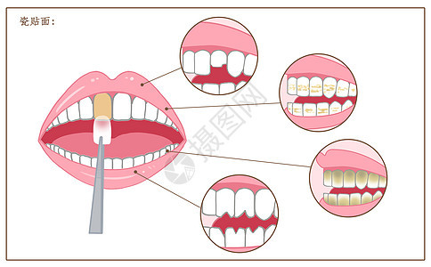 牙齿瓷贴面修复口腔医学配图图片