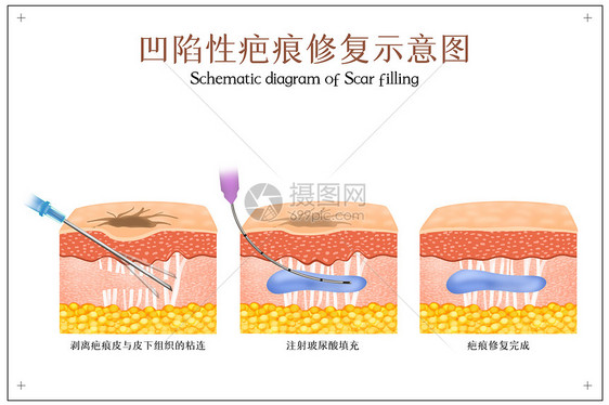 凹陷性疤痕修复示意图图片