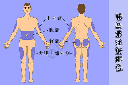 糖尿病患者胰岛素注射部位图片