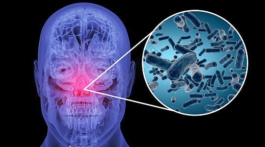 鼻塞人体鼻炎场景设计图片
